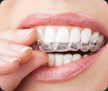 The Benefits and Risks of Using Insurance to Pay for Invisalign Treatment